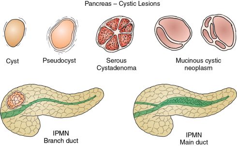 سرطان پانکراس (Pancreatic Cancer) چیست؟