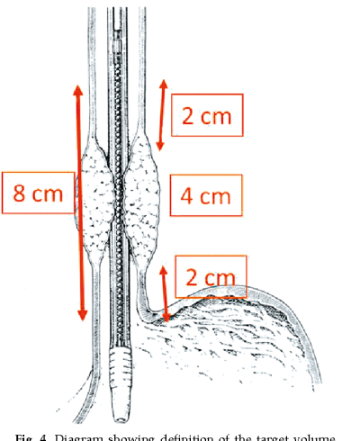 درمان سرطان مری