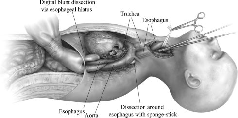 درمان سرطان مری