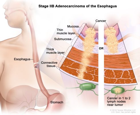 سرطان مری (Esophagus Cancer) چیست؟