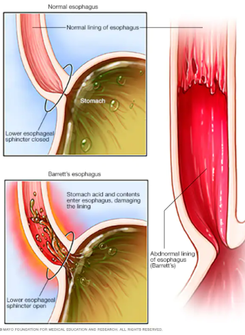 سرطان مری (Esophagus Cancer) چیست؟