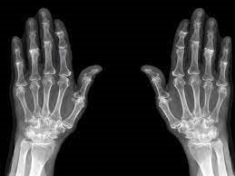 استئوآرتریت خفیف چیست؟ / و 100ها مطلب علمی