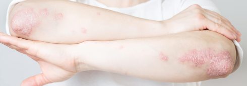 علل پسوریازیس