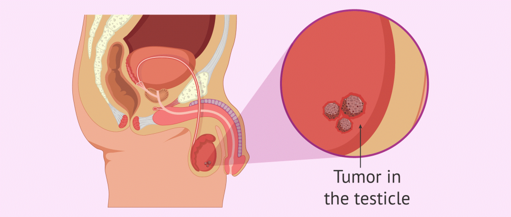سرطان بیضه (testicular cancer) چیست؟