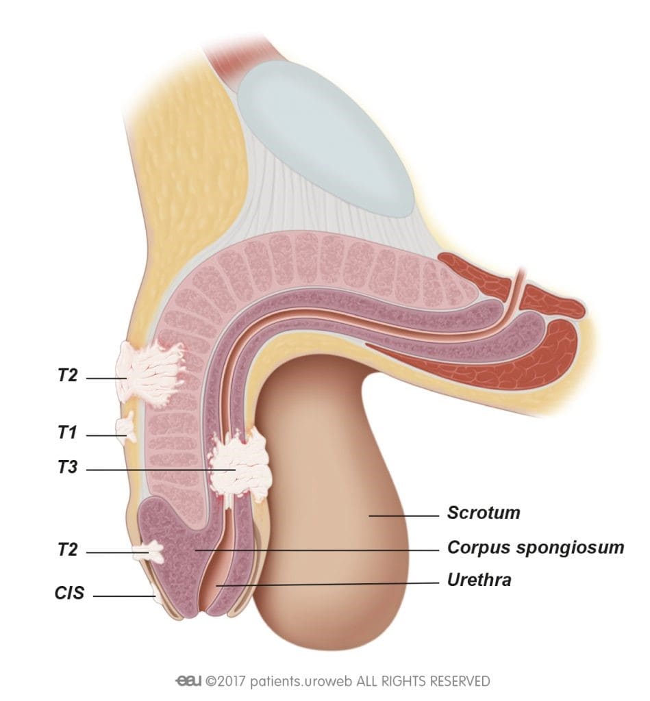 سرطان آلت تناسلی (Penile Cancer) چیست؟ | ژنیران