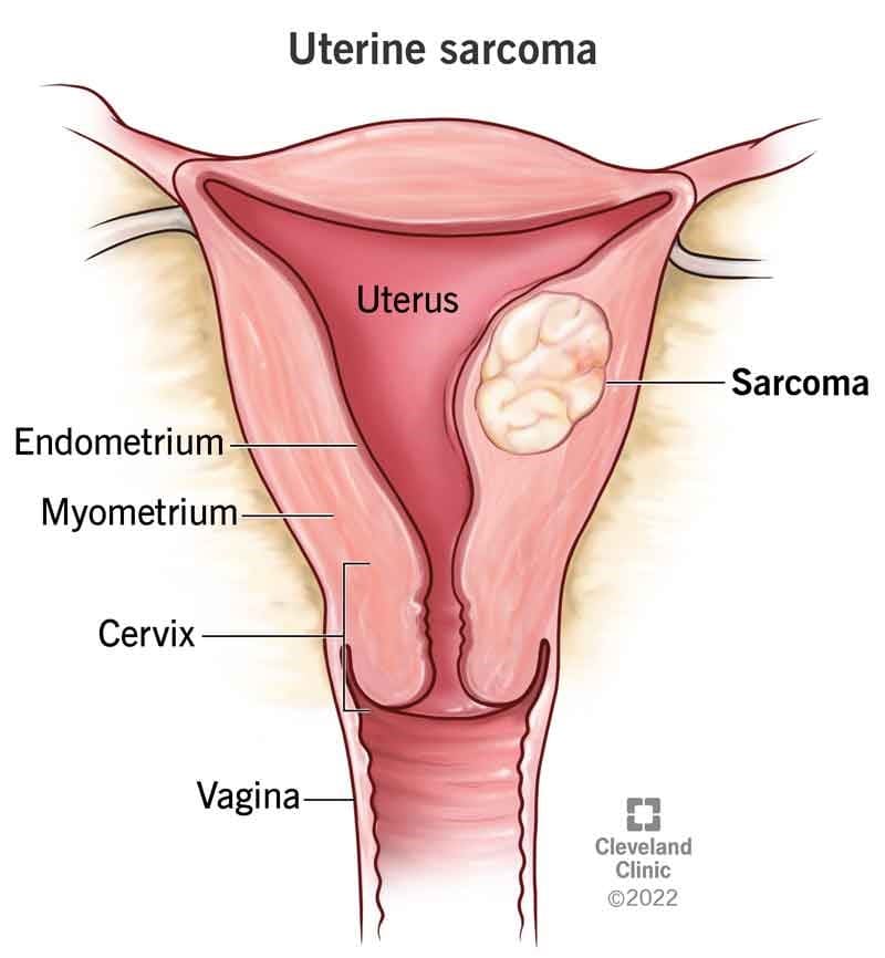 سارکوم رحم (Uterine Sarcoma) چیست؟