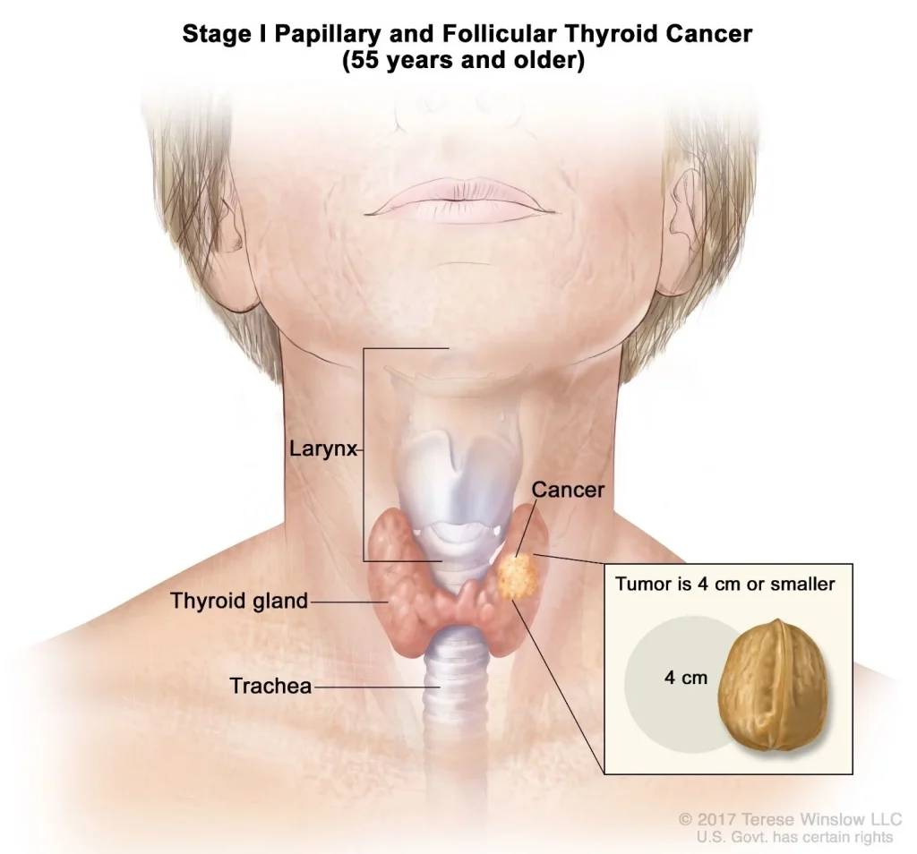 سرطان تیروئید (Thyroid Cancer) چیست؟