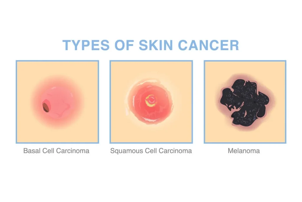 سرطان پوست سلول بازال و سنگفرشی چیست؟